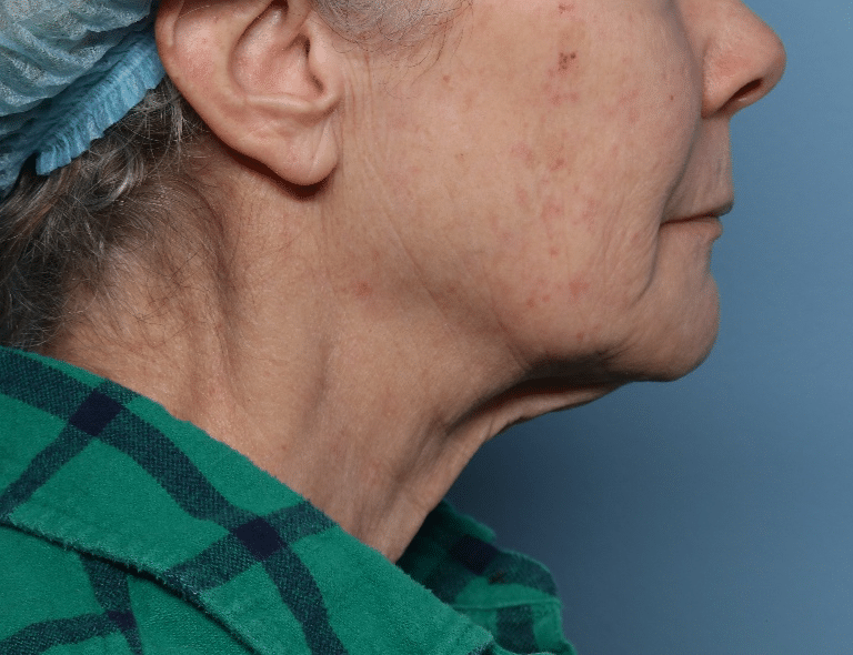 Before Image: Fractional CO2 -