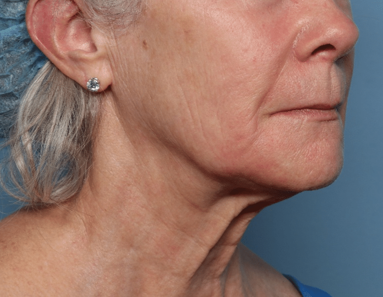 After Image: Fractional CO2 - right-front-oblique