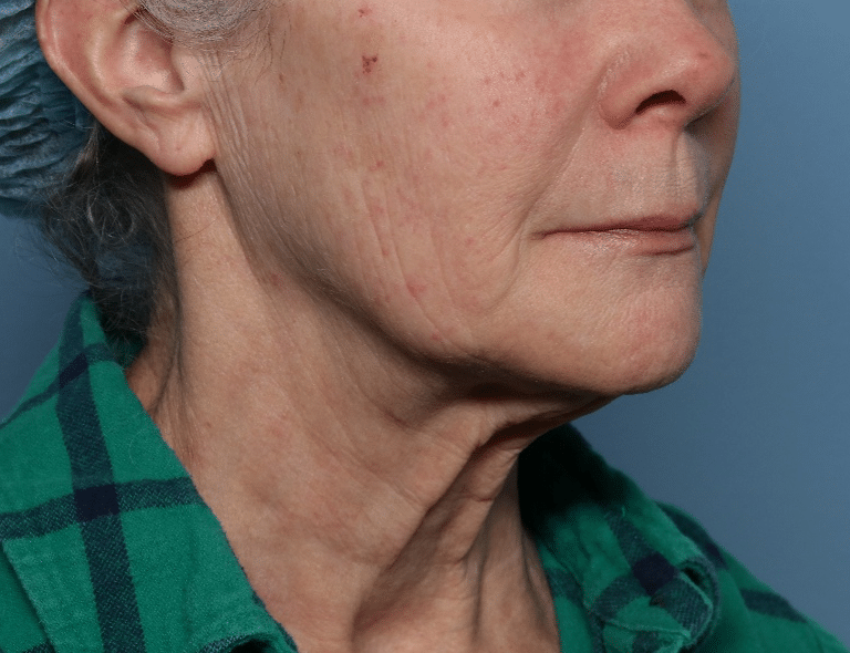 Before Image: Fractional CO2 - right-front-oblique