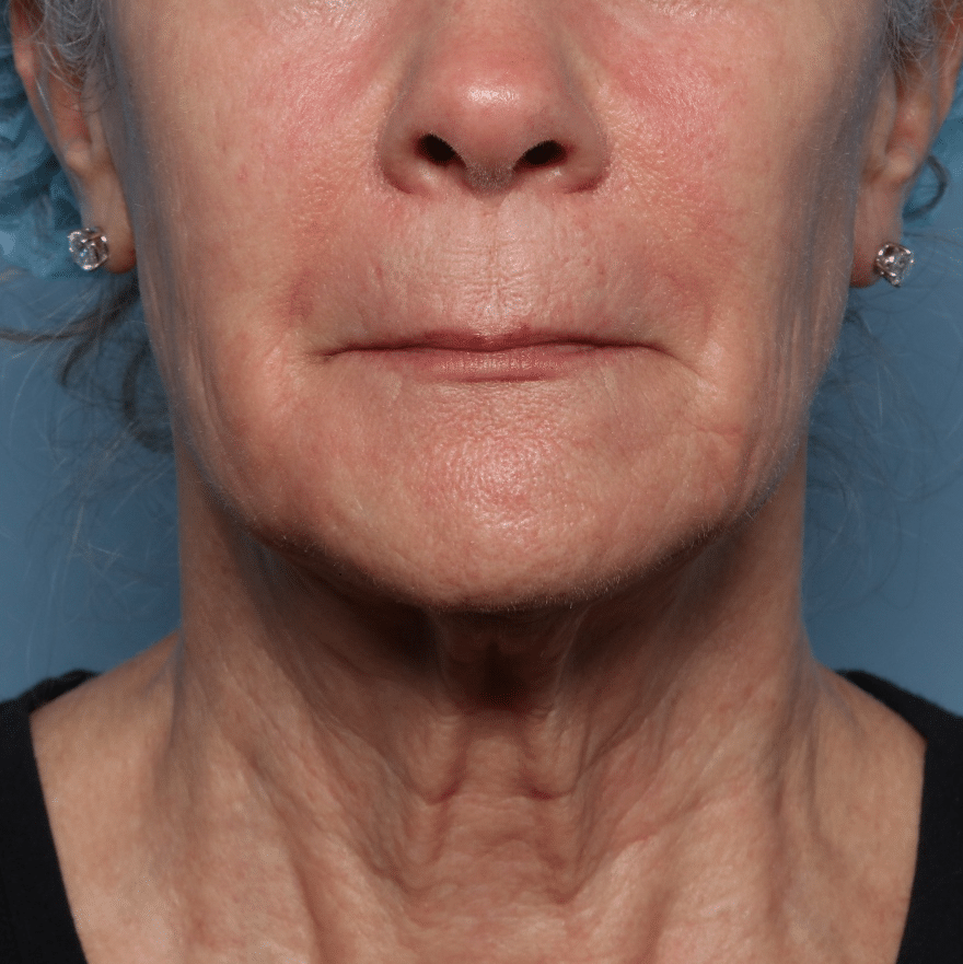 After Image: Fractional CO2 - front