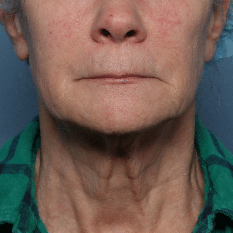 Before Image: Fractional CO2 - front