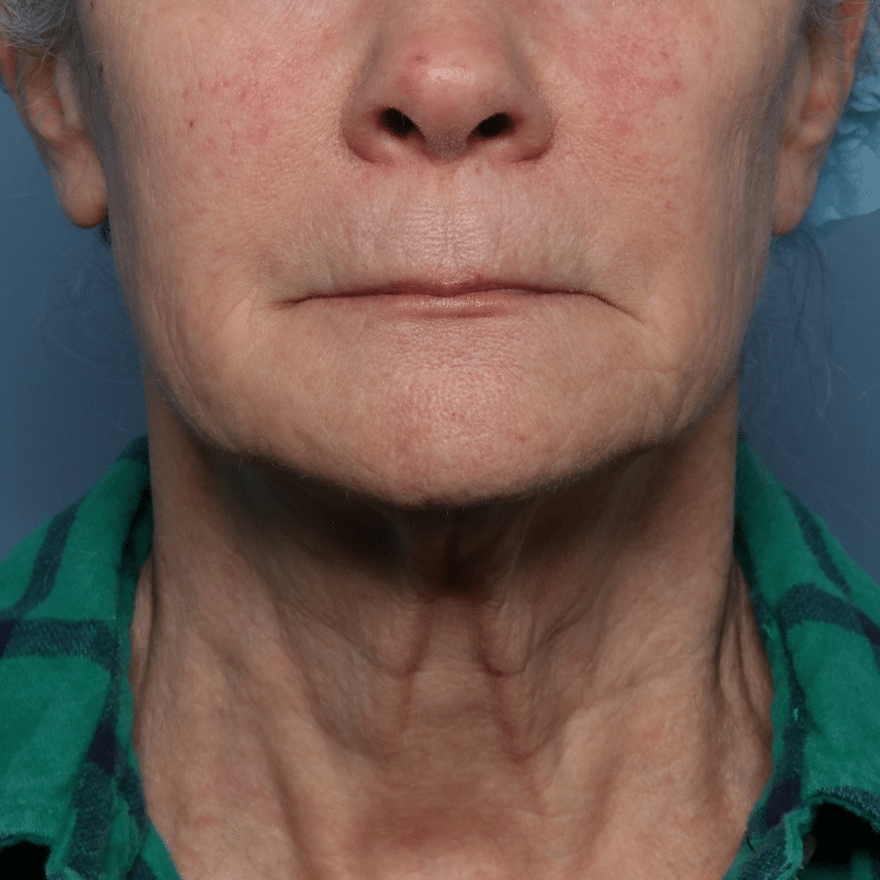 Before Image: Fractional CO2 - front