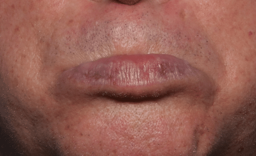 After Image: Venous Lake Treatment - front