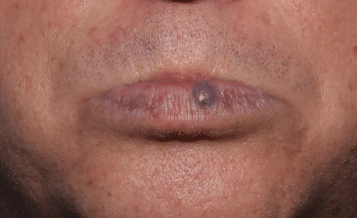 Before Image: Venous Lake Treatment - front
