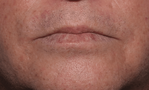 After Image: Venous Lake Treatment - front