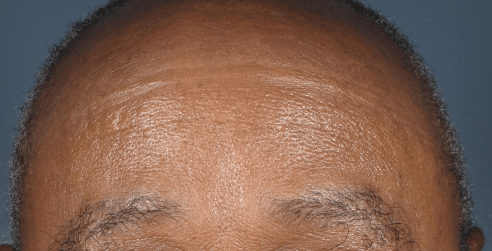 After Image: Iriderm Laser - front