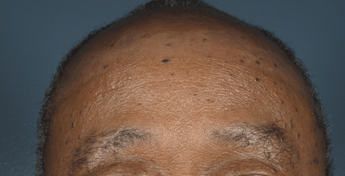 Before Image: Iriderm Laser - front