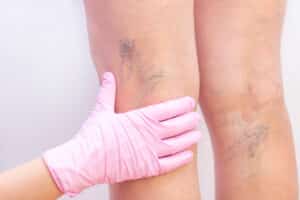 Doctor touching back of patient's legs to examine spider veins