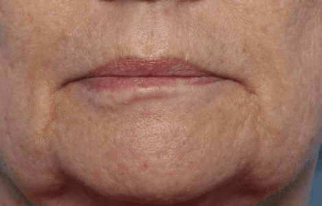 After Image: Venous Lake Treatment - front