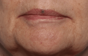 Before Image: Venous Lake Treatment