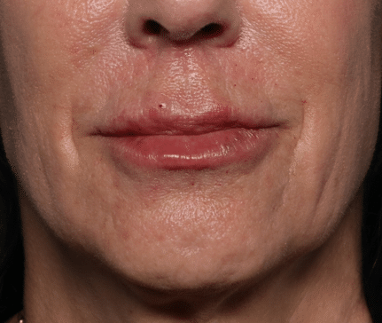 After Image: Filler - front