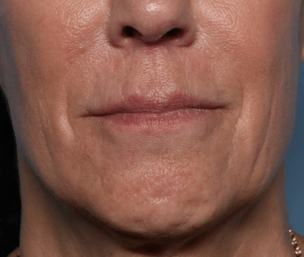 Before Image: Filler - front