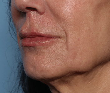 After Image: Filler - left-front-oblique