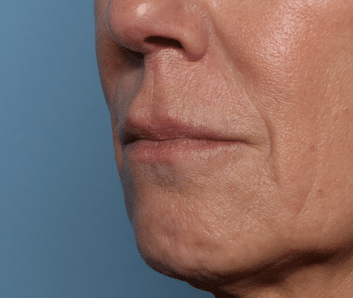 Before Image: Filler - left-front-oblique