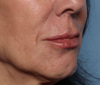 After Image: Filler - right-front-oblique