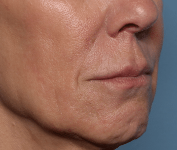 Before Image: Filler - right-front-oblique