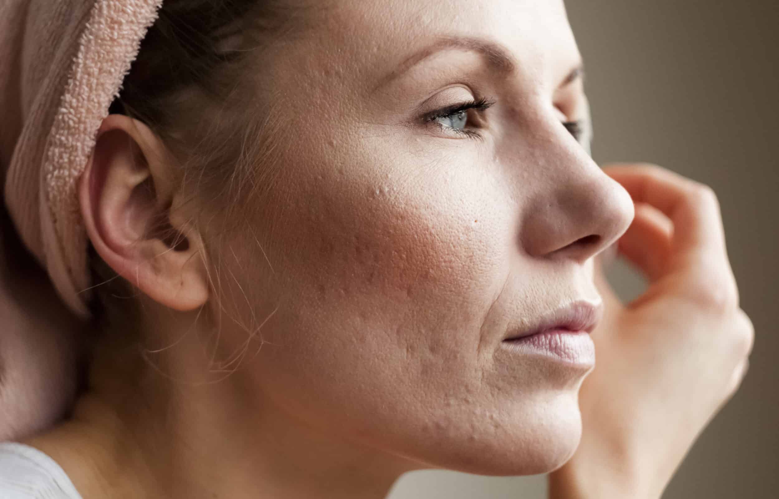Woman with acne scars on cheeks