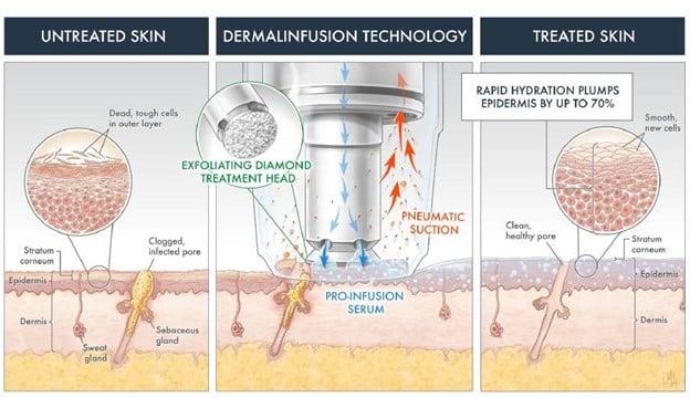 1763569421_dermalinfusion-2
