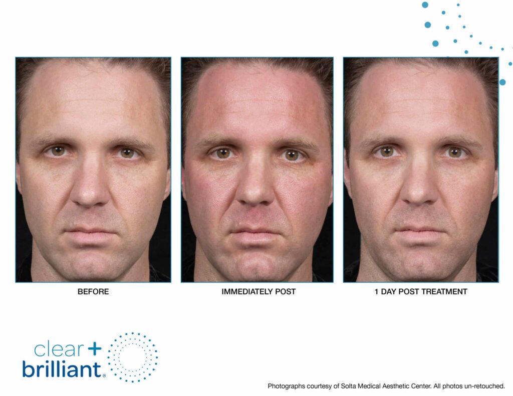 1763569903_CB-Before-After-SMAC_01-scaled