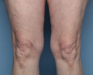 After Image: Thermage – Above the Knees