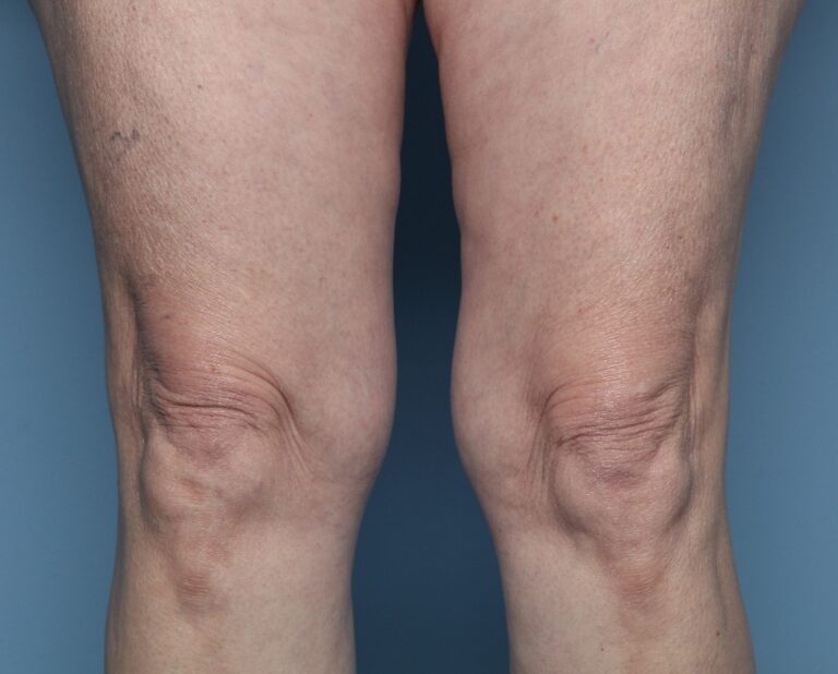 After Image: Thermage – Above the Knees - front