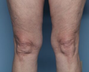 Before Image: Thermage – Above the Knees