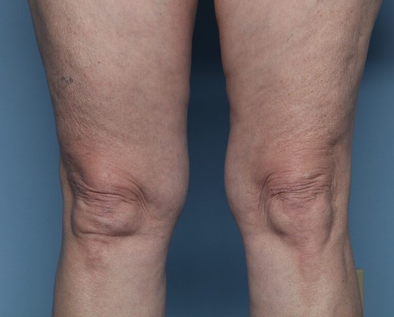 Before Image: Thermage – Above the Knees - front
