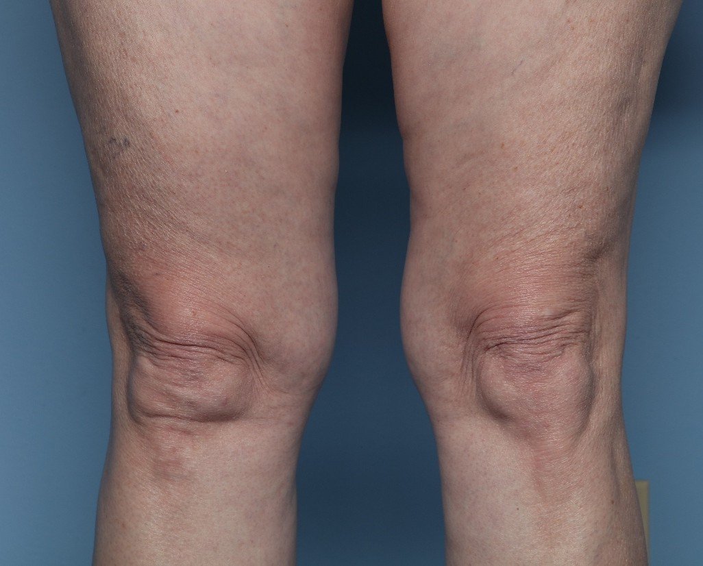 Before Image: Thermage – Above the Knees - front