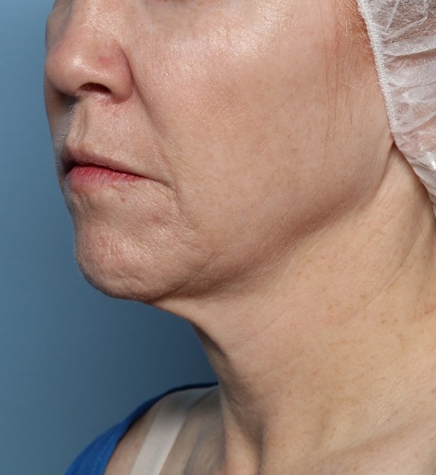 After Image: Fractional CO2: ActiveFX and DeepFX - left-front-oblique