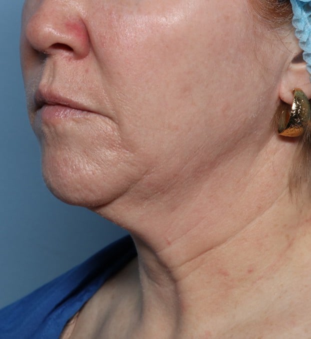 Before Image: Fractional CO2: ActiveFX and DeepFX - left-front-oblique