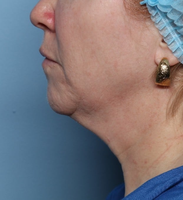 Before Image: Fractional CO2: ActiveFX and DeepFX -