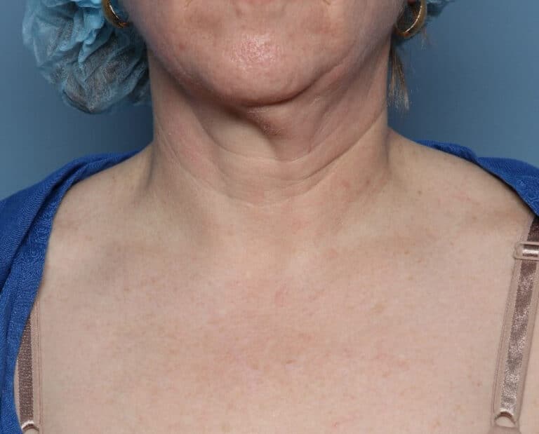 Before Image: Fractional CO2: ActiveFX and DeepFX - front