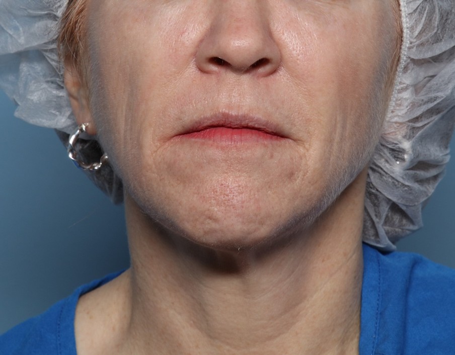 After Image: Fractional CO2: ActiveFX and DeepFX - front