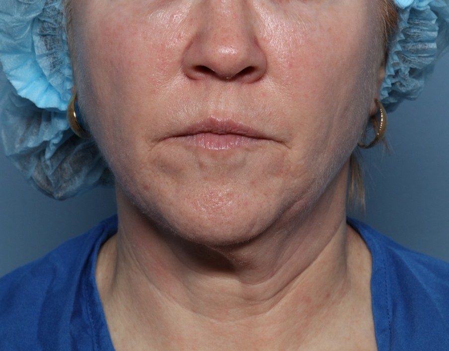 Before Image: Fractional CO2: ActiveFX and DeepFX - front