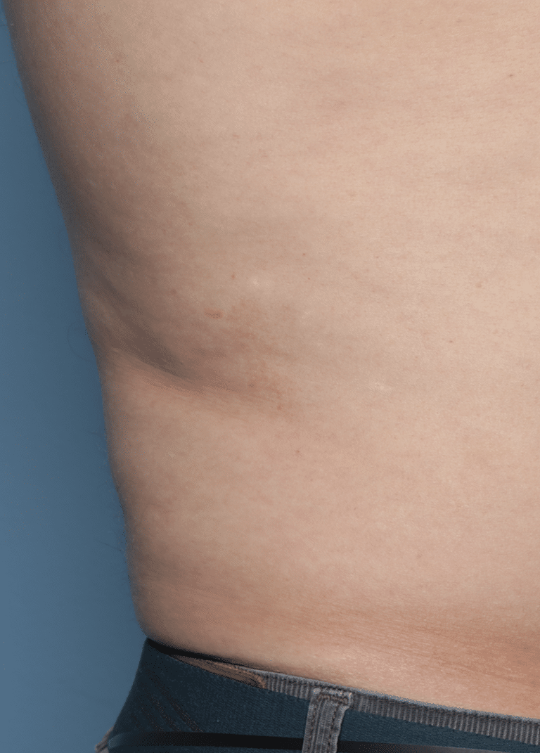 After Image: CoolSculpting – Flanks - front