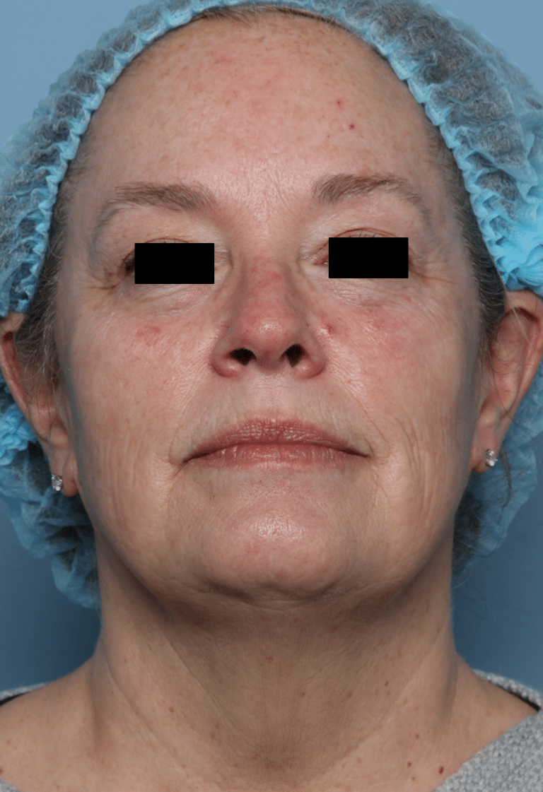 After Image: MedLite Laser Treatment - front