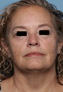Before Image: MedLite Laser Treatment