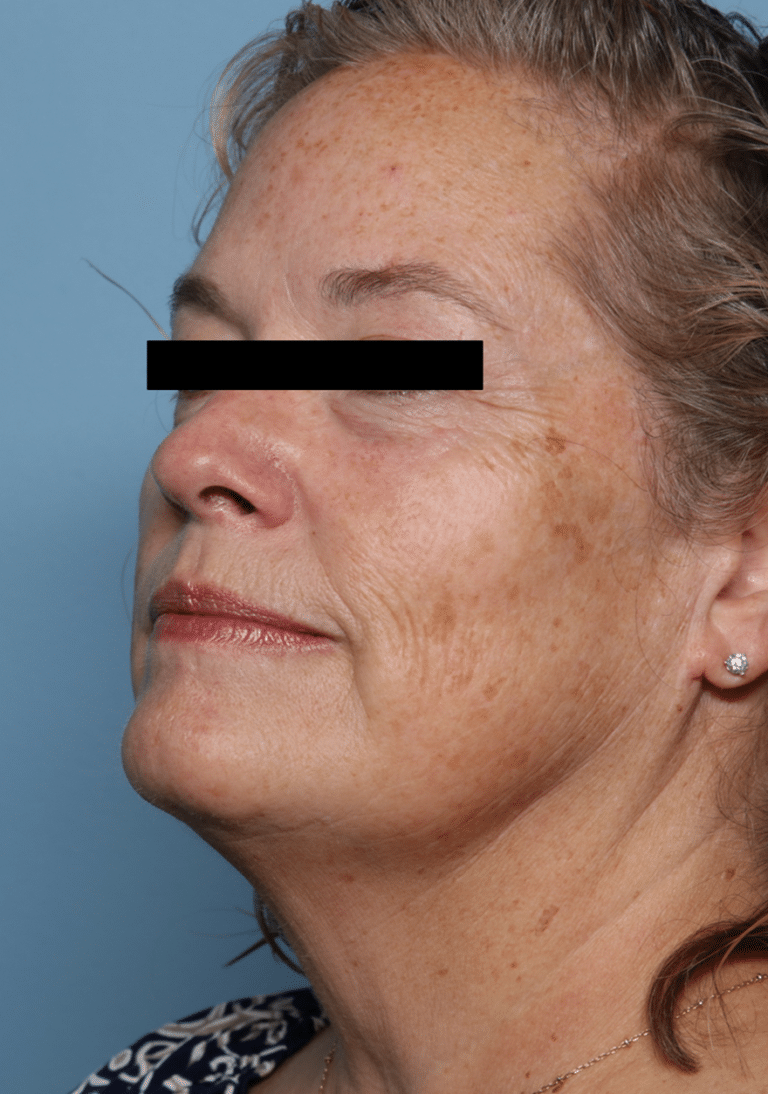 Before Image: MedLite Laser Treatment - right-side