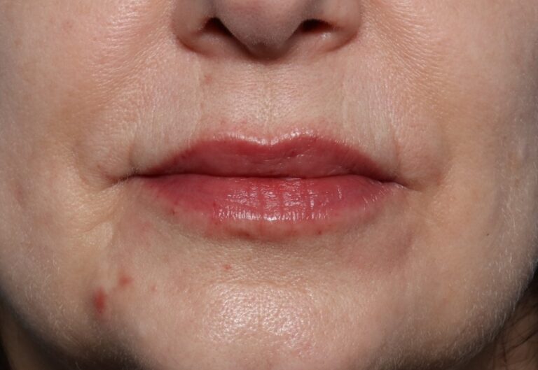 After Image: Lip Filler - front