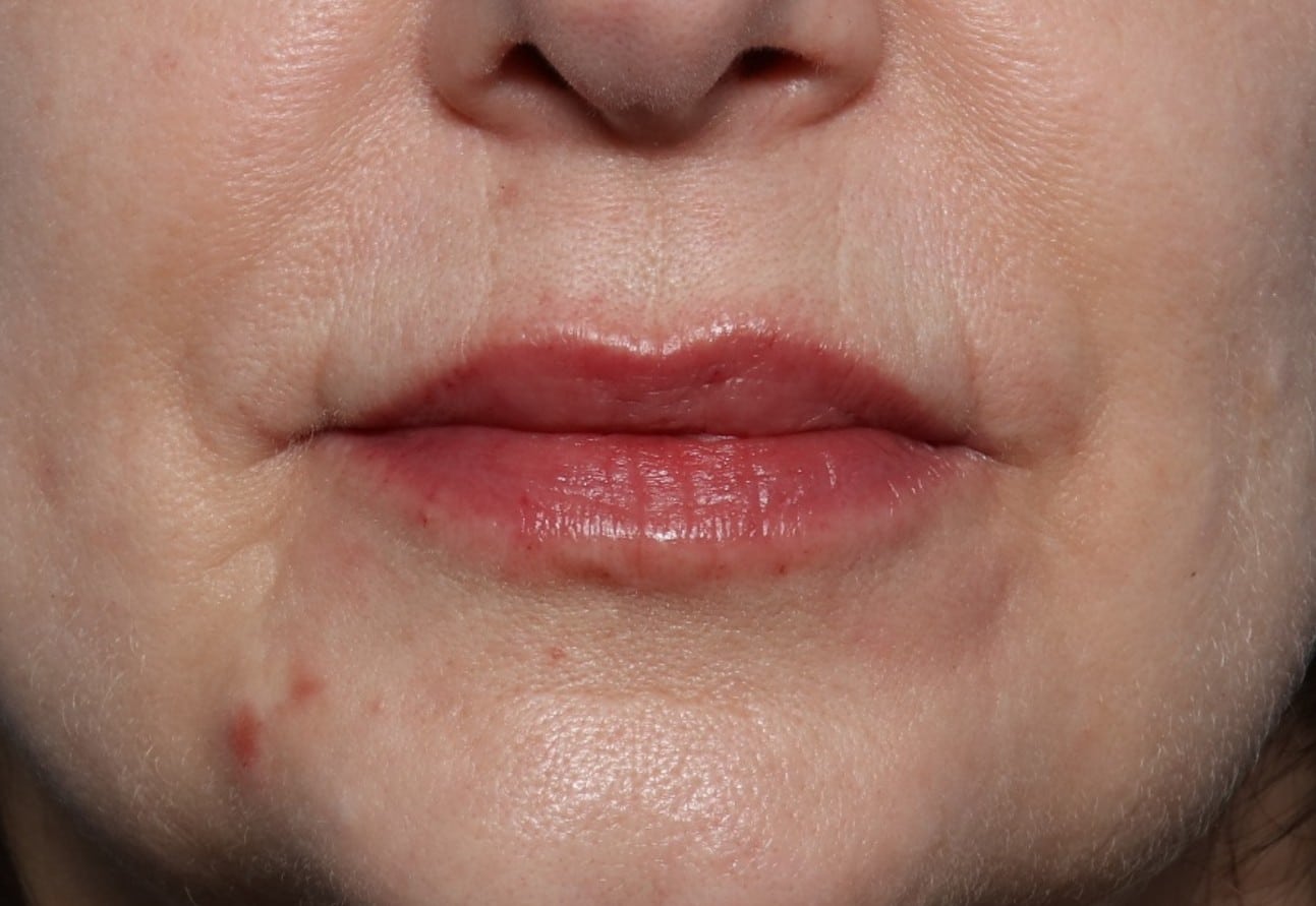 After Image: Lip Filler - front