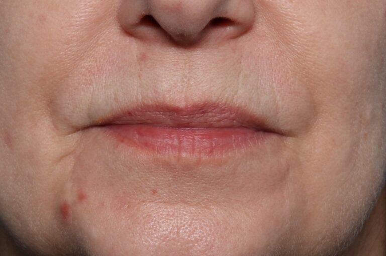 Before Image: Lip Filler - front