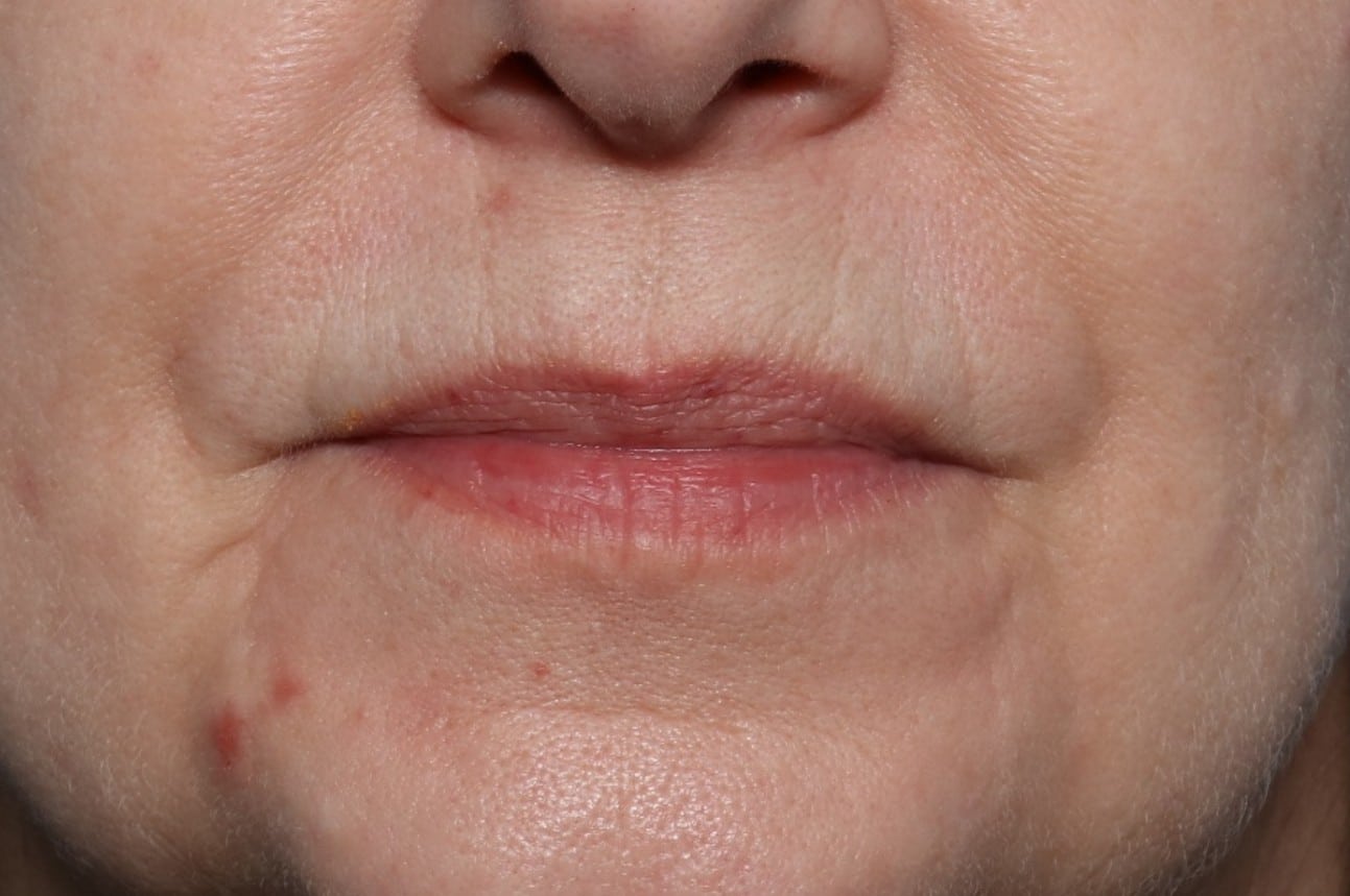 Before Image: Lip Filler - front