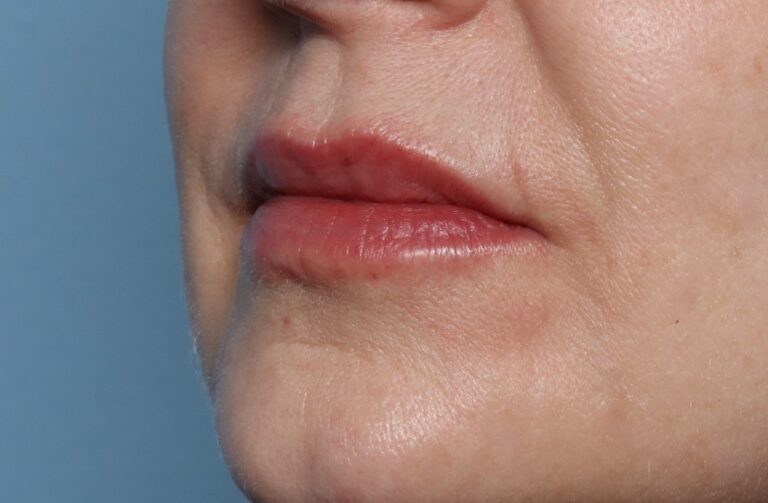 After Image: Lip Filler -