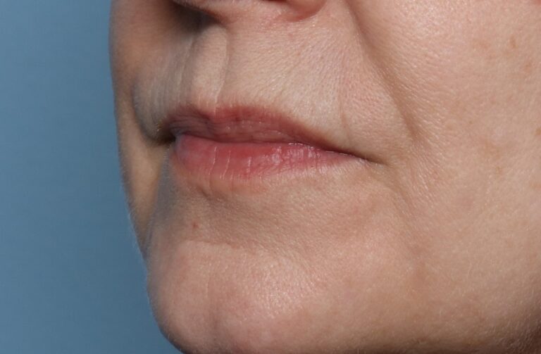 Before Image: Lip Filler -