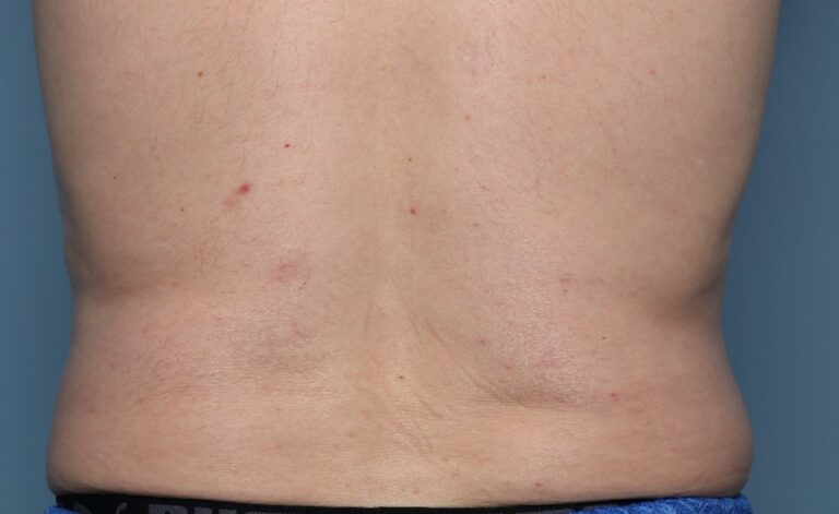 Before Image: CoolSculpting – Flanks - front