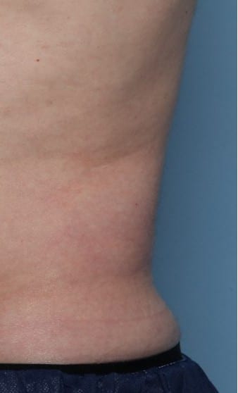 Before Image: CoolSculpting – Flanks - front