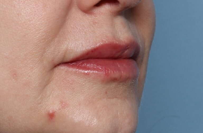 After Image: Lip Filler -