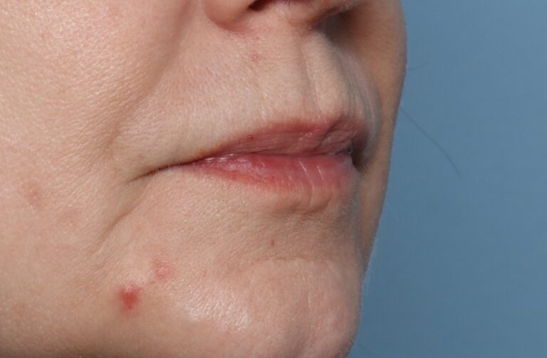 Before Image: Lip Filler -