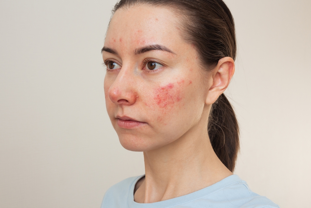 Woman with visible facial redness and irritation on her cheek before discussing VBeam laser treatment options. Woman with visible facial redness and irritation on her cheek before discussing VBeam laser treatment options.