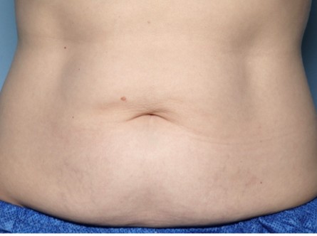 After Image: Thermage – Abdomen - front
